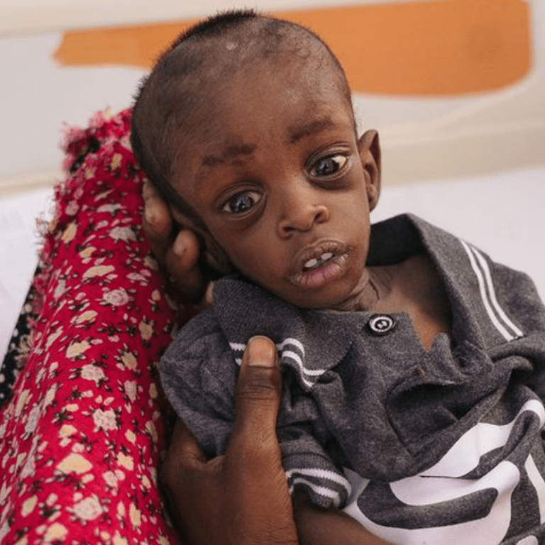 A ten-month-old boy is treated for severe malnutrition at a hospital in Puntland, Somalia.