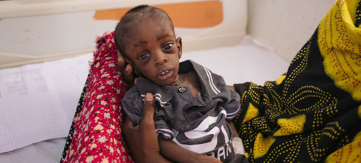  A ten-month-old boy is treated for severe malnutrition at a hospital in Puntland, Somalia.  